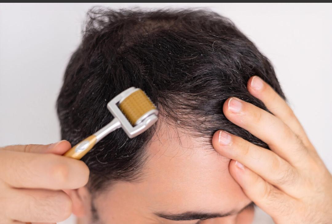 Microneedling