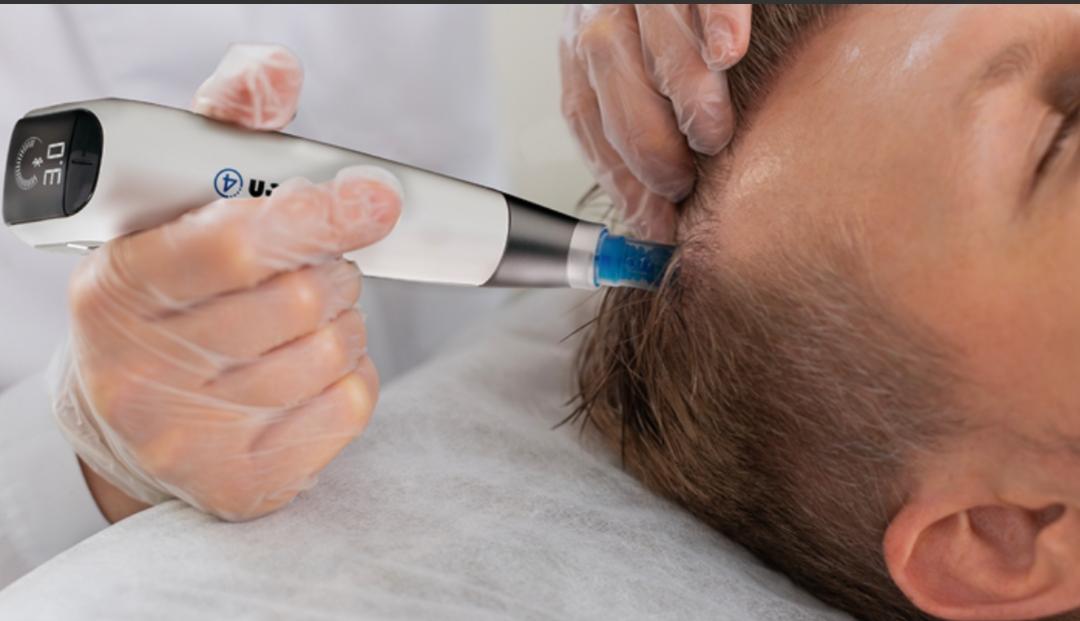 Microneedling