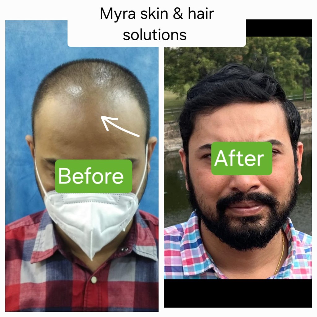 Hair Transplant Before After