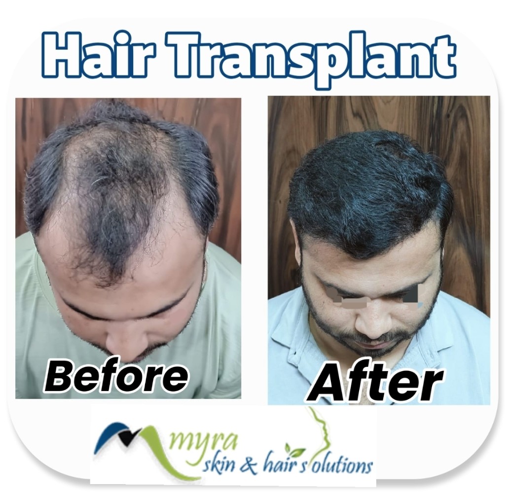 Hair Transplant Results