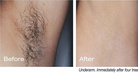 Update 73+ underarm laser hair removal cost - in.eteachers