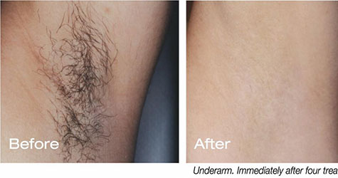 Ful Body Laser Hair Removal Cost Delhi  Dr Syed