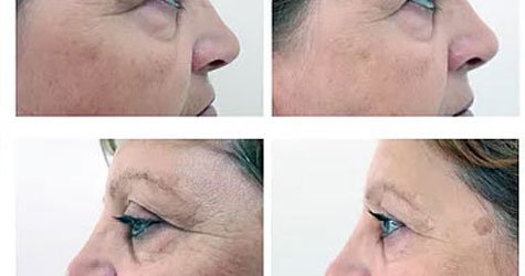 Mesotherapy Issue