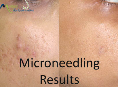 Microneedling