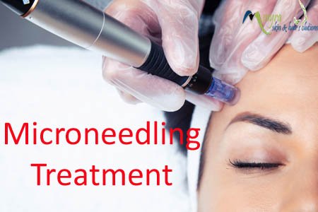 Microneedling