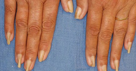 nail disorders