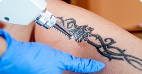 The Tattoo Vanish Method  Learn Why No Other Tattoo Removal Method  Compares  Best Tattoo Removal Without Laser Laserless  Painless NonLaser  Tattoo Removal Near Me  Tattoo Vanish