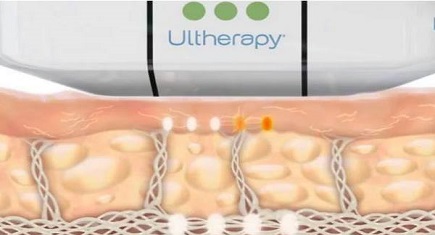 Ultherapy