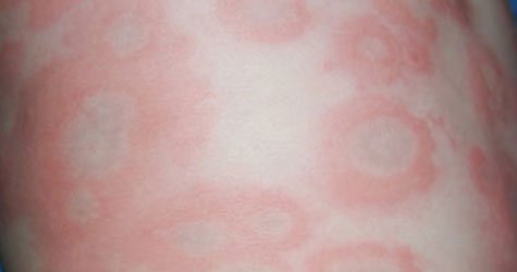 urticaria