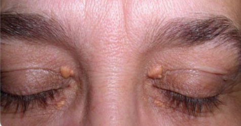 xanthelasma palpebrarum